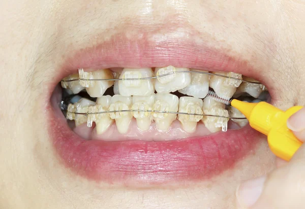 Close up crooked teeth with braces, interdental brushing