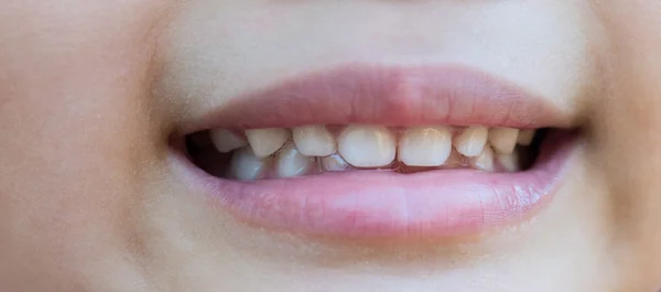 Closeup of the opened mouth of a child with a saliva