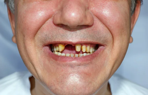 Man smile with peeled teeth