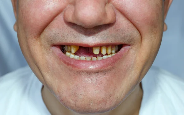 Men with peeled teeth