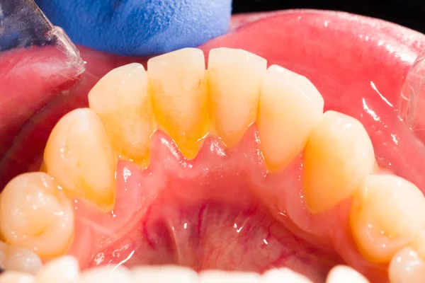 Dental plaque in human mouth