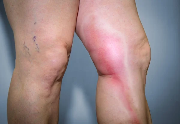 Thrombophlebitis in human leg