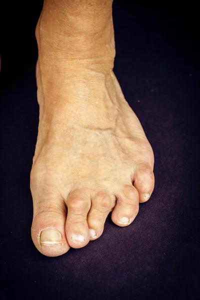 Rrheumatoid arthritis toe deformities