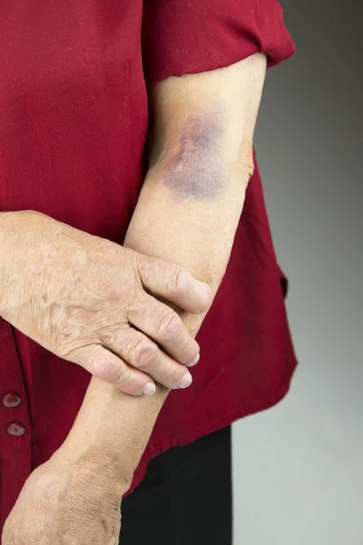 Large hematoma on human arm