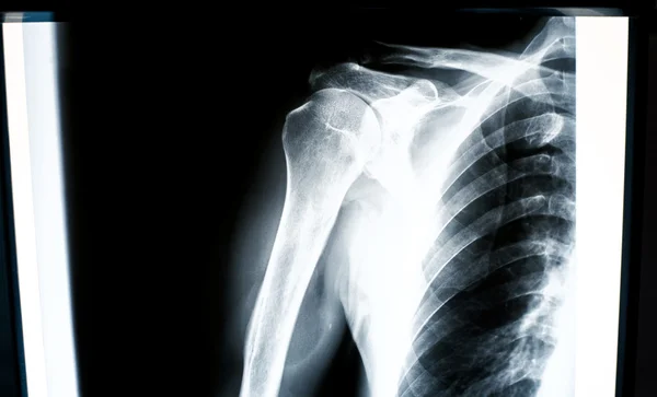 X-ray of shoulder