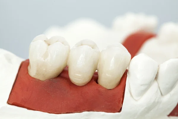 Metal free ceramic dental crowns