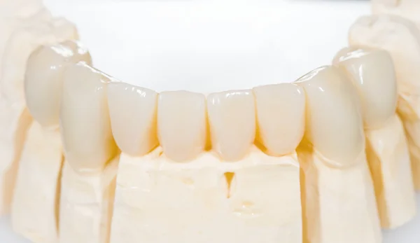 Dental ceramic bridge