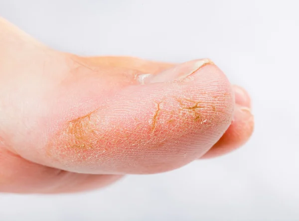 Dry skin on big toe