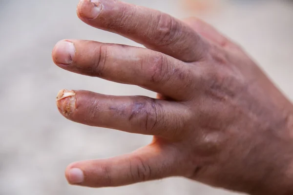 Damaged finger after operation. Man's hand with stitches and pins still in place from surgery to repair damage from Dupuytren's Contracture of pinky finger.