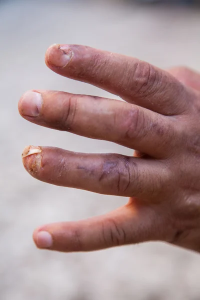 Damaged finger after operation. Man\'s hand with stitches and pins still in place from surgery to repair damage from Dupuytren\'s Contracture of pinky finger.