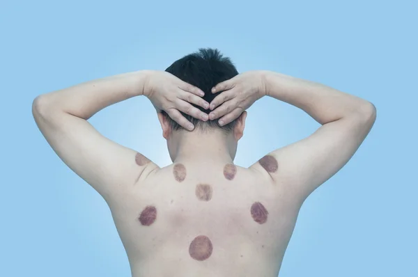 Asian man with marking of vacuum cupping