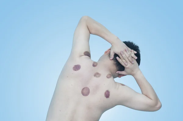 Asian man with marking of vacuum cupping