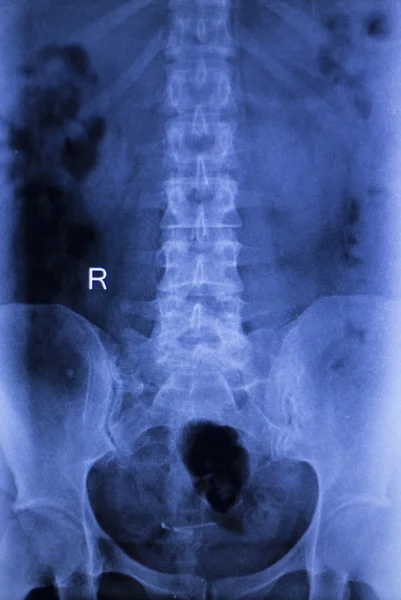 Spine vertebra back injury xray scan