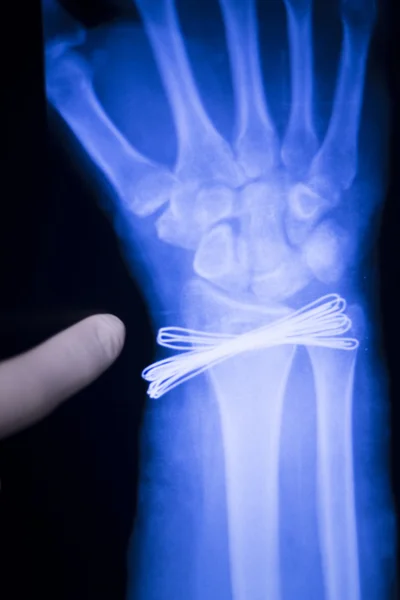 Wrist injury metal implant xray scan