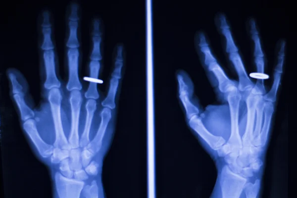 Hand and finger injury xray scan