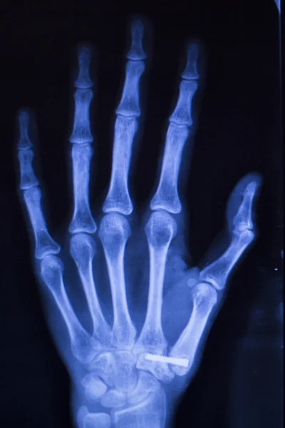 Hand injury fingers xray scan