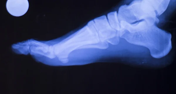 Foot ankle injury xray scan