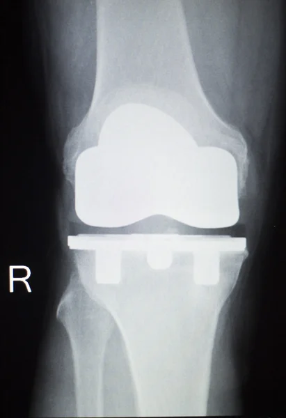 Knee joint orthopedics implant xray