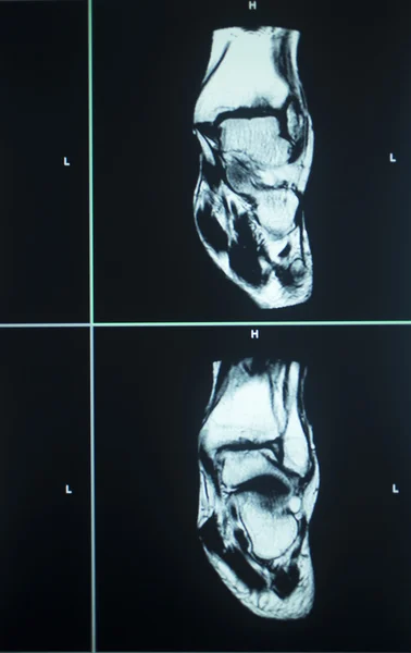 MRI scan test results ankle injury