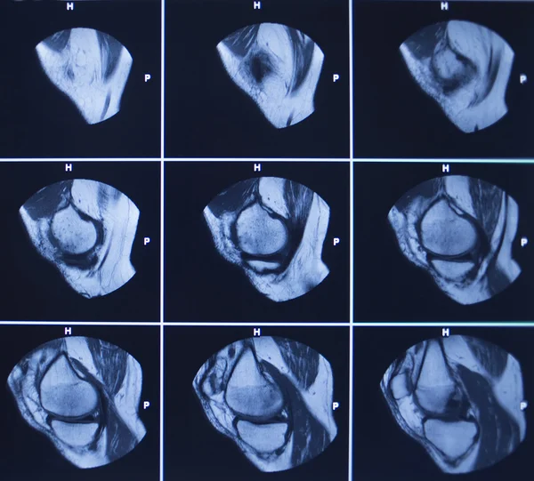 MRI scan test results knee meniscus injury