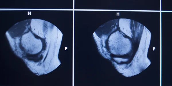 MRI scan test results knee meniscus injury