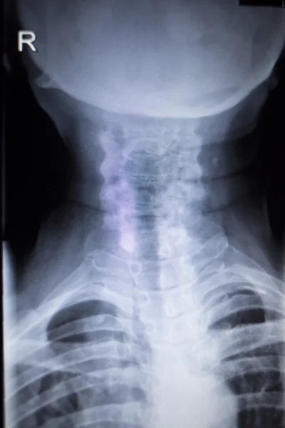 X-ray orthopedics Traumatology scan of neck injury