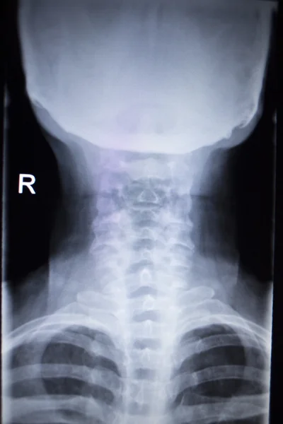 X-ray orthopedics Traumatology scan of neck injury