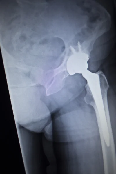 X-ray scan  image of hip joint replacement orthopedic implant