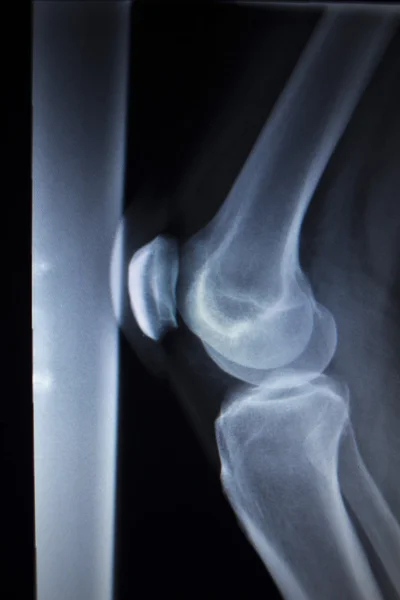 X-ray orthopedics scan of painful knee meniscus leg injury