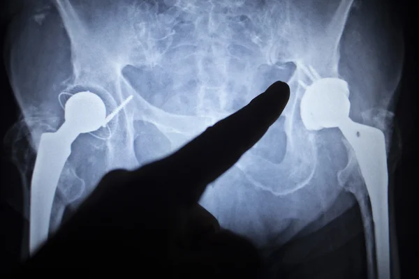 X-ray scan  image of hip joint replacement orthopedic implant