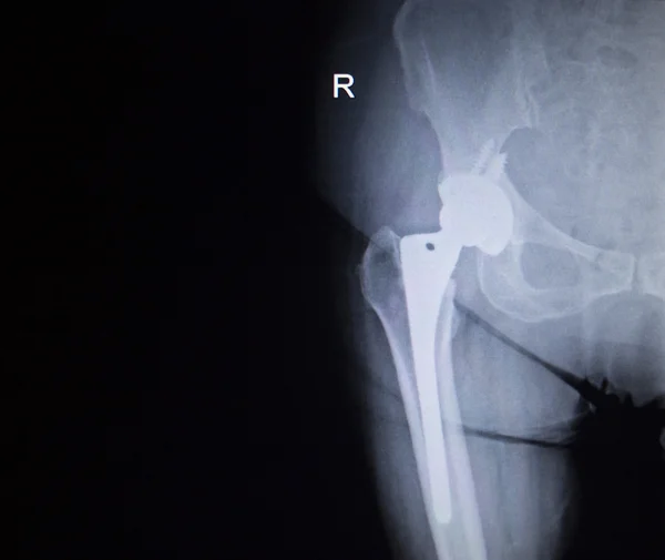 X-ray scan  image of hip joint replacement orthopedic implant