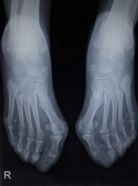 X-ray orthopedics scan of foot injury anterior posterior AP