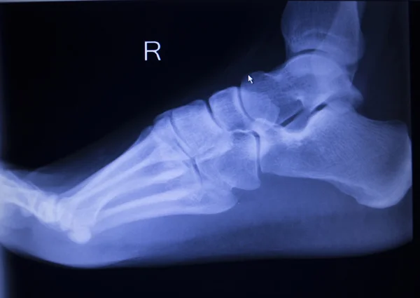 X-ray orthopedics scan of foot injury