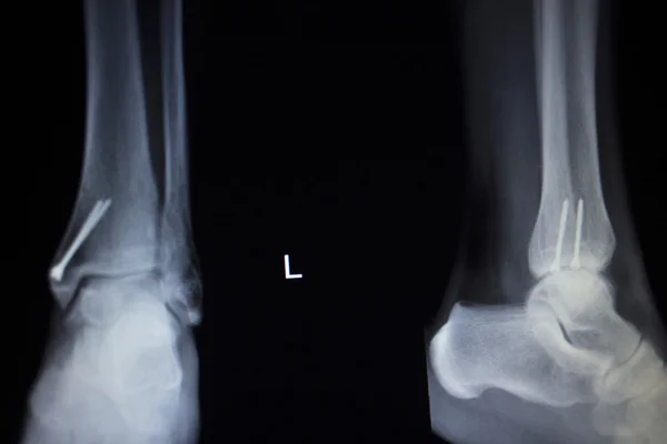 X-ray orthopedics scan of ankle foot injury screw implant