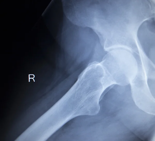 X-ray orthopedic scan image of hip joints human skeleton