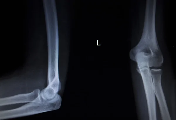 X-ray orthopedics Traumatology scan of elbow joint injury