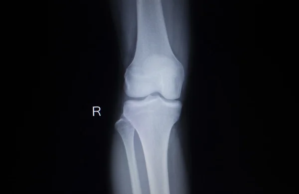 X-ray orthopedics scan of painful knee meniscus leg injury