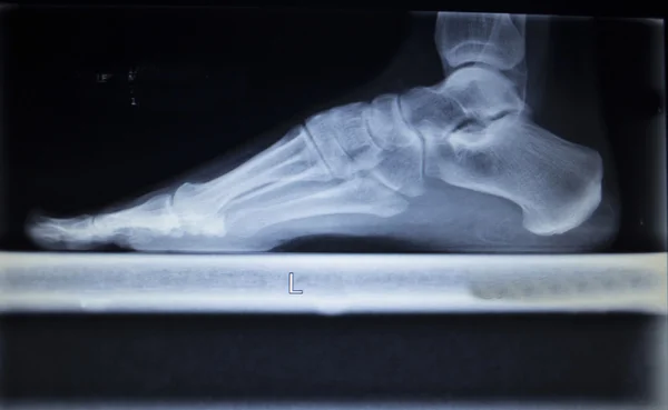 X-ray orthopedics scan of foot injury load weight bearing