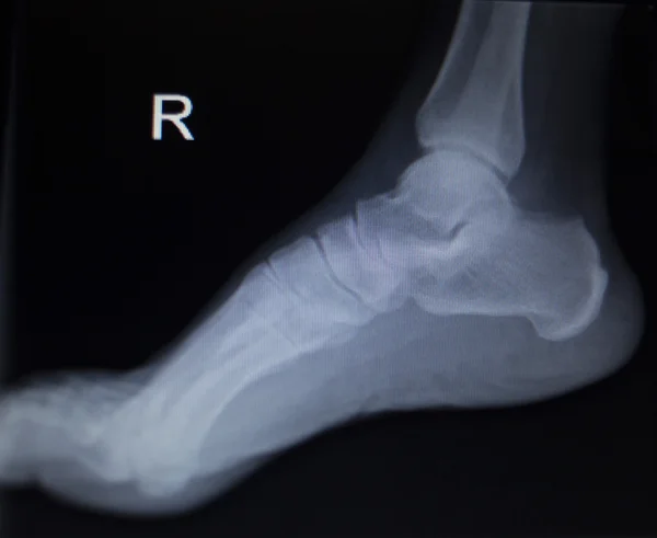 X-ray orthopedics scan of foot injury