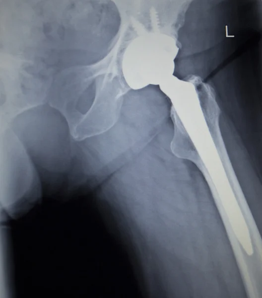 X-ray scan  image of hip joint replacement orthopedic implant