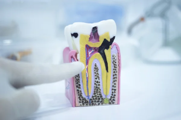 Dental tooth model cast showing decay enamel roots