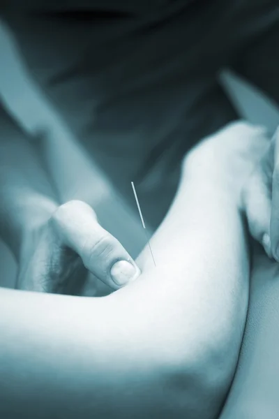 Doctor hand acupuncture needle patient arm