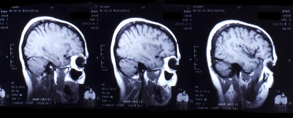 Picture of computed tomography the brain. Black and white.