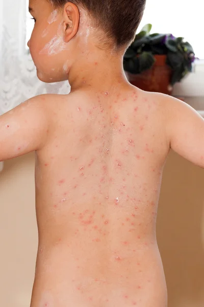 Detail baby with chicken pox rash