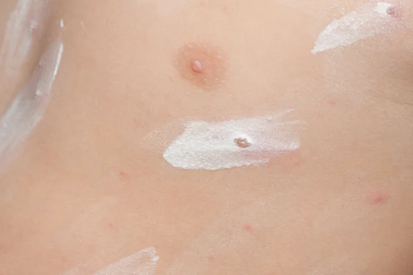 Detail baby with chicken pox rash