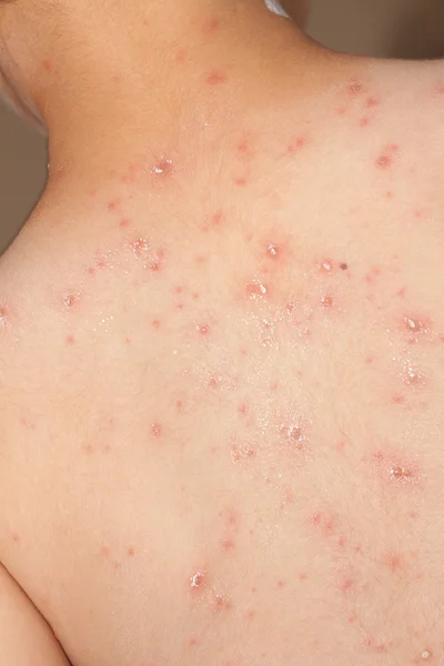 Detail baby with chicken pox rash