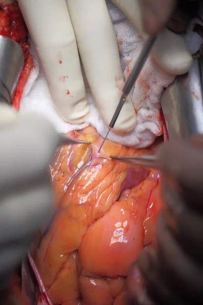 Operation on the heart vessels