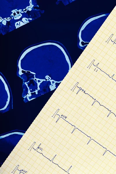 ECG and ct scan of human brain