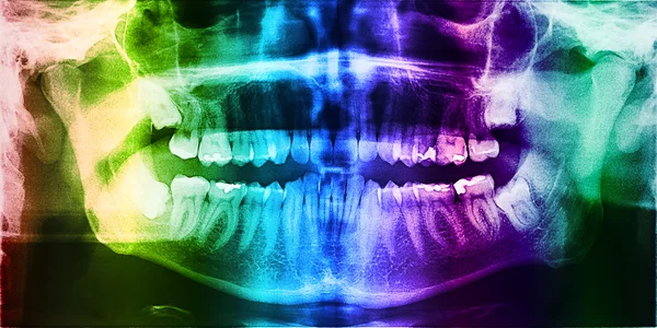 Dental X-Ray Of Teeth