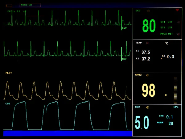 Electrocardiogram screen monitor